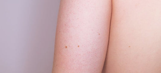 Managing Keratosis Pilaris