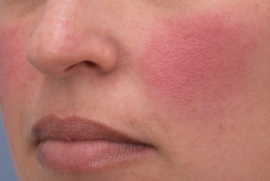 Treating rosacea in summer