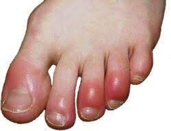 Chilblains not COVID toes